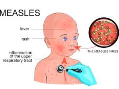 Image of Measles Information Letter